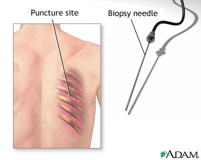 Lung biopsy Lung biopsy
