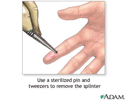 Splinter removal Splinter removal
