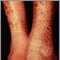 Ichthyosis, acquired - legs